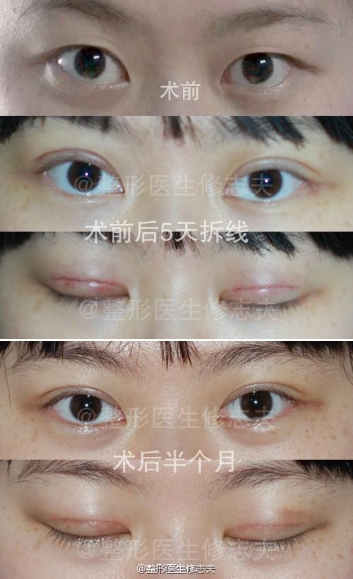 切开法双眼皮恢复