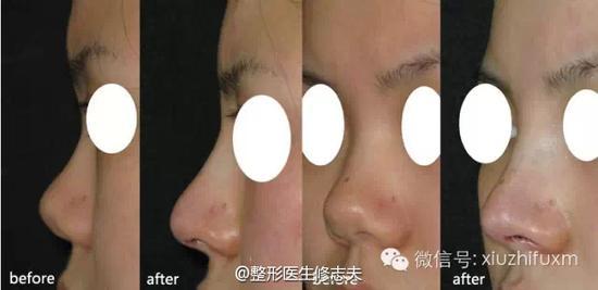 鼻综合整形前后效果