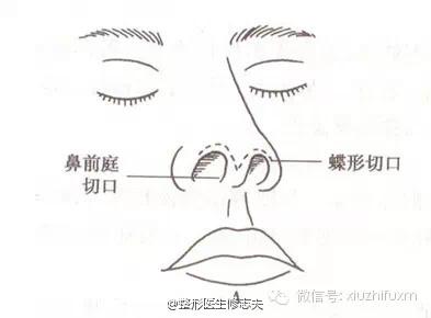 切口