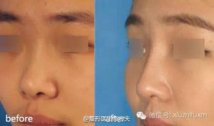 假体隆鼻前后效果