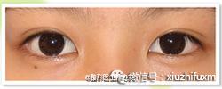 开扇型双眼皮