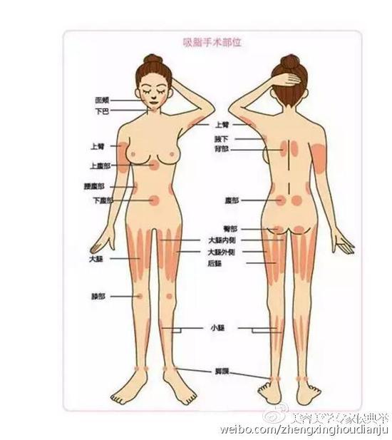身体可吸脂的部位
