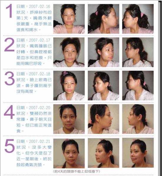 削骨恢复1
