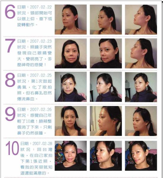 削骨恢复2