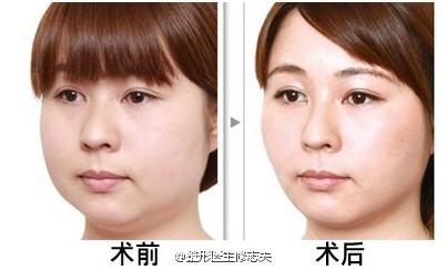面部吸脂