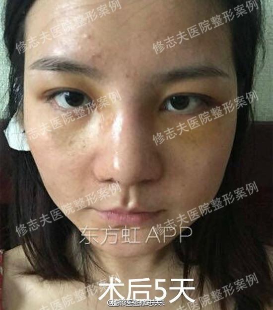 术后第五天
