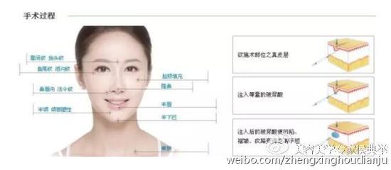 注射肉毒素,防止皱纹再生