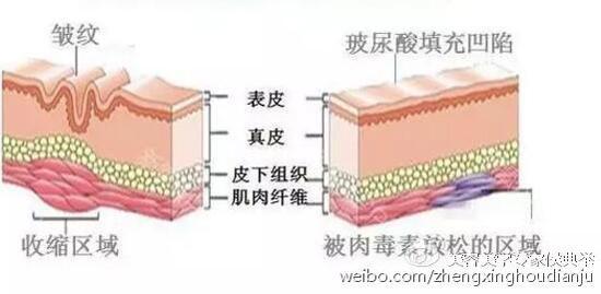 注射玻尿酸,填充凹陷