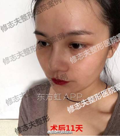 术后第11天