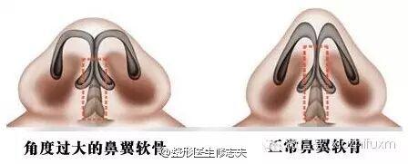造成蒜头鼻的“元凶”