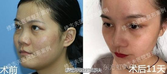 术前术后对比