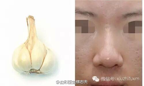 蒜头鼻