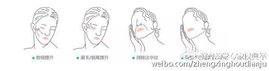埋蛋白线,提升面部