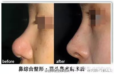 鼻综合整形前后