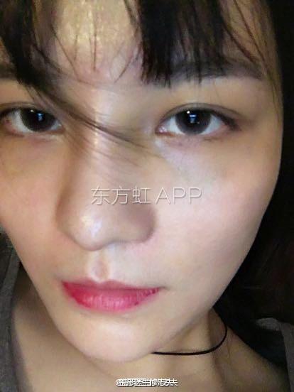 术后
