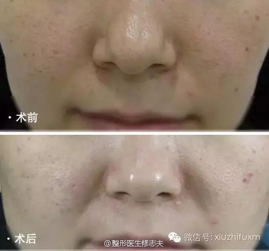 蒜头鼻矫正案例前后对比