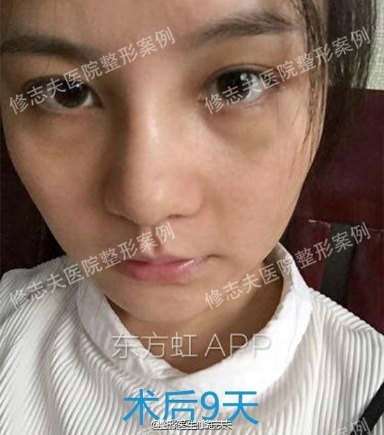 术后第九天