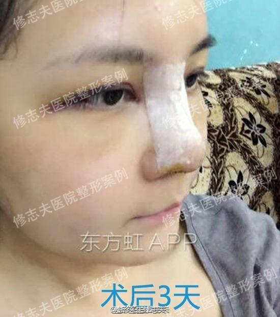 手术后第三天