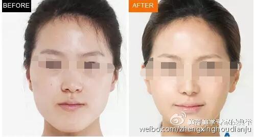 苹果肌注射