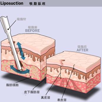 吸脂减肥原理