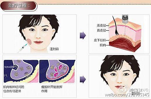 肉毒素的作用机制