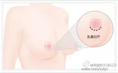 假体丰胸手术切口