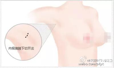 假体丰胸手术切口