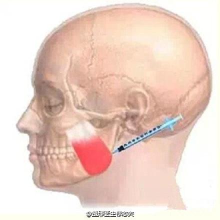 注射肌肉层次不到位