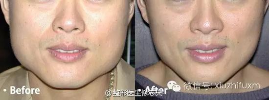下颌角骨质肥大