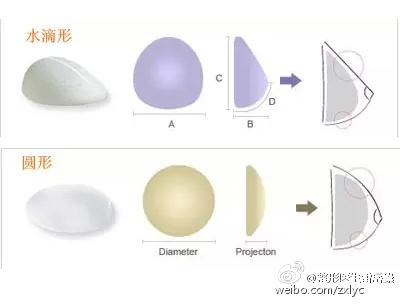 假体形状