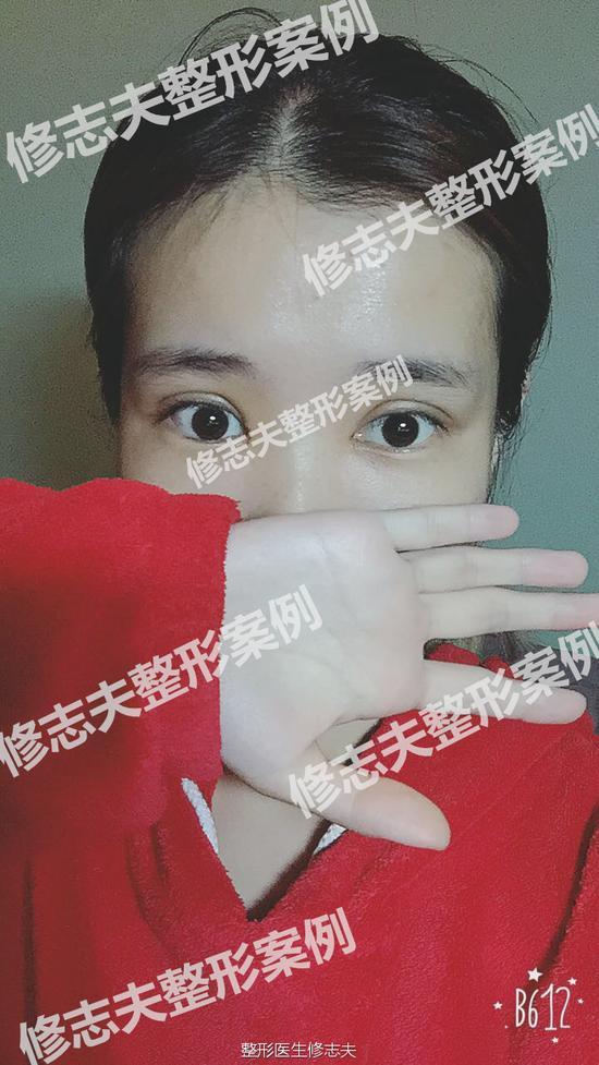 术后第7天