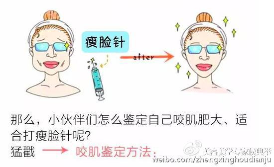 瘦脸针
