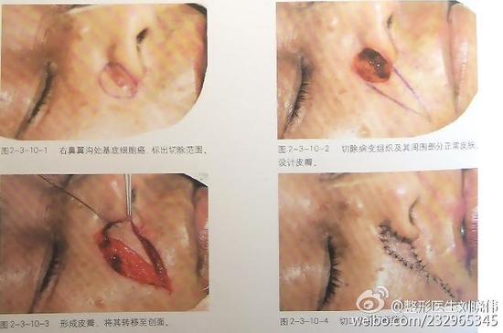 风筝皮瓣