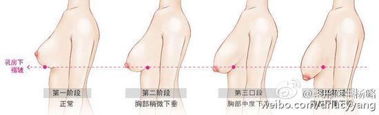 乳房下垂