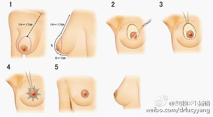 改善乳房下垂