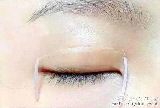 贴双眼皮贴