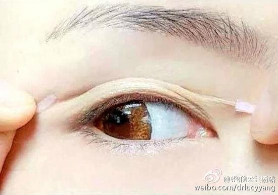贴双眼皮