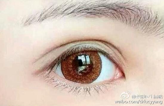 变成双眼皮