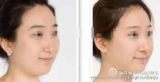 垫鼻子