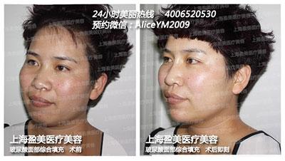 玻尿酸填充