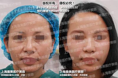 自体脂肪填充