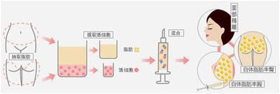 自体脂肪填充
