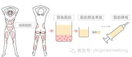 自体脂肪移植术原理