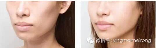 丰额头/颊/太阳穴