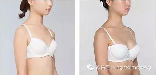 丰胸