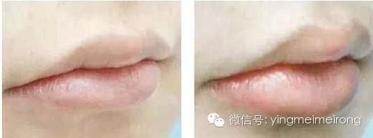 丰唇