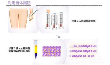 自体脂肪填充鼻唇沟