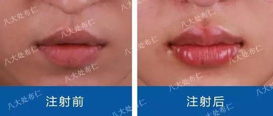 丰唇