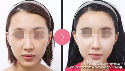 玻尿酸