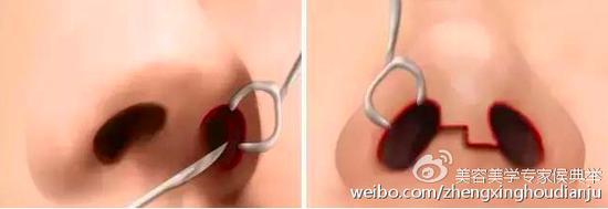 术后不留痕